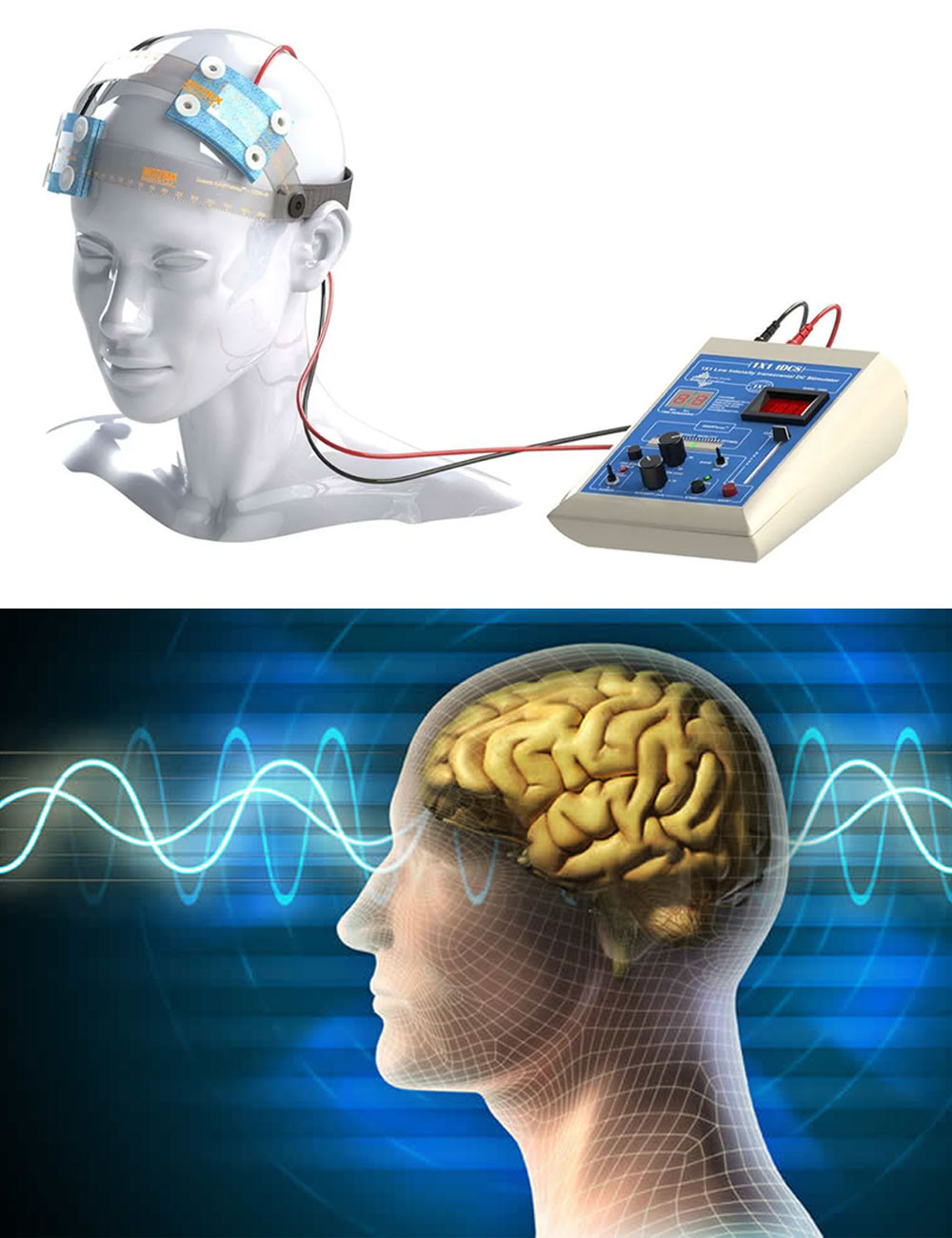 Transcranial Direct Current Stimulation (tDCS) Therapy